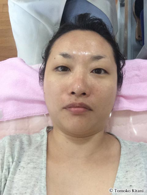 大邱でワクワクドキドキの美容鍼体験にチャレンジ 成功する留学 大邱でワクワクドキドキの美容鍼体験にチャレンジ 成功する留学