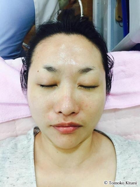 大邱でワクワクドキドキの美容鍼体験にチャレンジ 成功する留学 大邱でワクワクドキドキの美容鍼体験にチャレンジ 成功する留学
